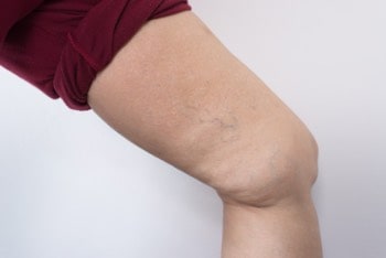 Varicose veins